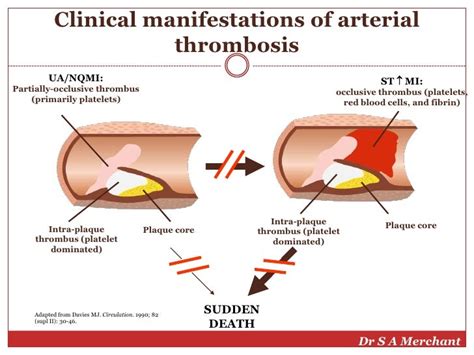 bg3 thrombus|Interventional thrombus modification in STEMI .